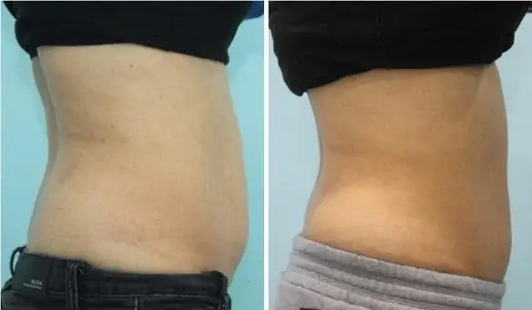 Abdominal contour, before and after (published study case) preview