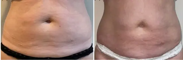 Abdomen across time points (published study case) preview