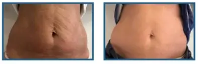 Abdominal skin texture, before and after (published study case) preview