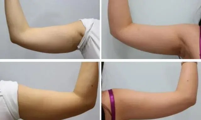Upper arm, before and after (published study case) preview