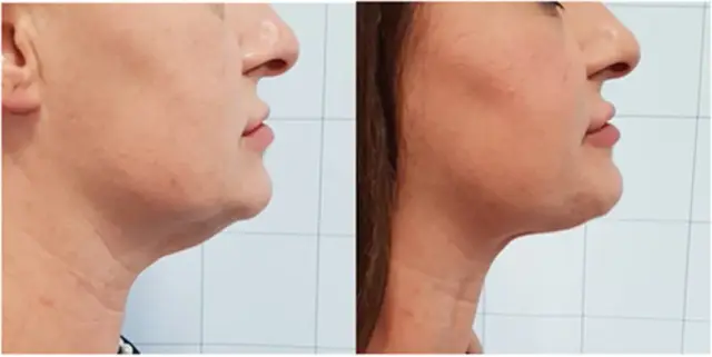 Jawline and double chin, side view before and after (published study case) preview