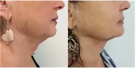 Under-chin contour, before and after (published study case) preview
