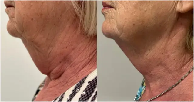 Neck and under-chin sagging, before and after (published study case) preview