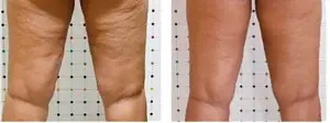 Back of the thigh, before and after (published study case) preview