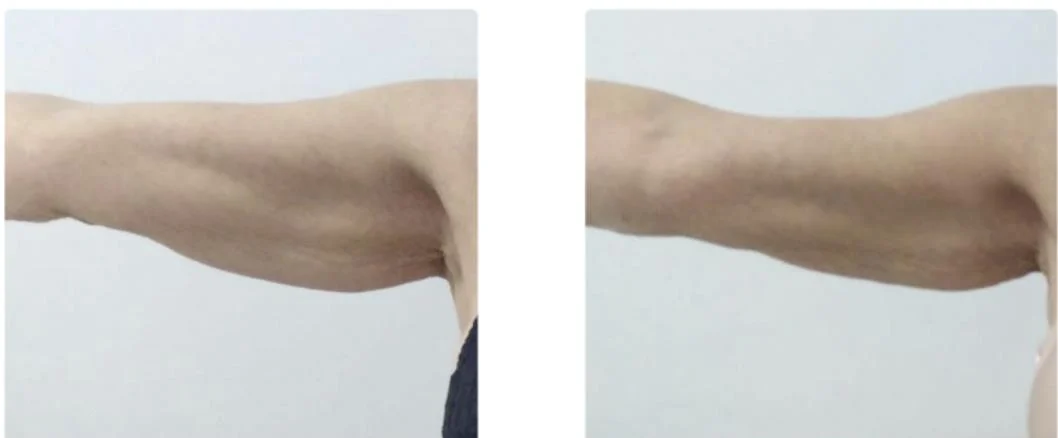 팔뚝 처짐 2회차 추적 비교 (논문 게재 사례) 미리보기
